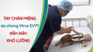 Bệnh tay chân miệng và virus EV71