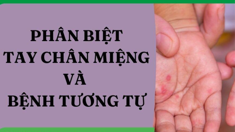 cách điều trị bệnh tay chân miệng tại nhà