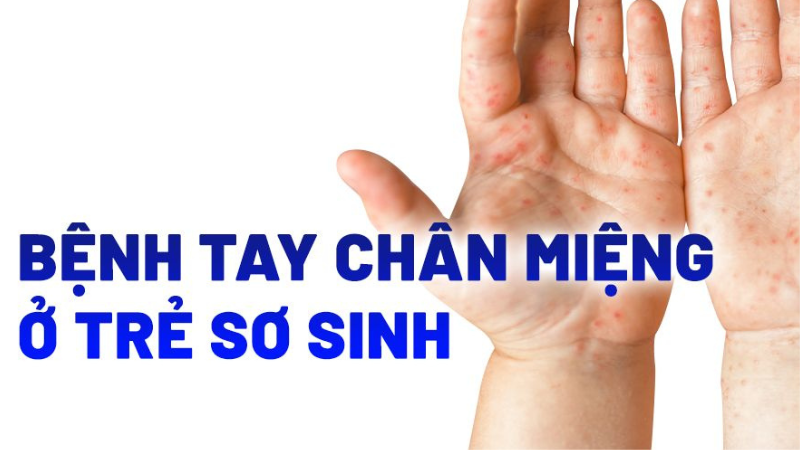 biểu hiện bệnh tay chân miệng