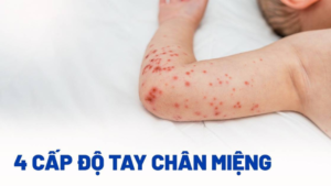 bệnh tay chân miệng cấp độ 1