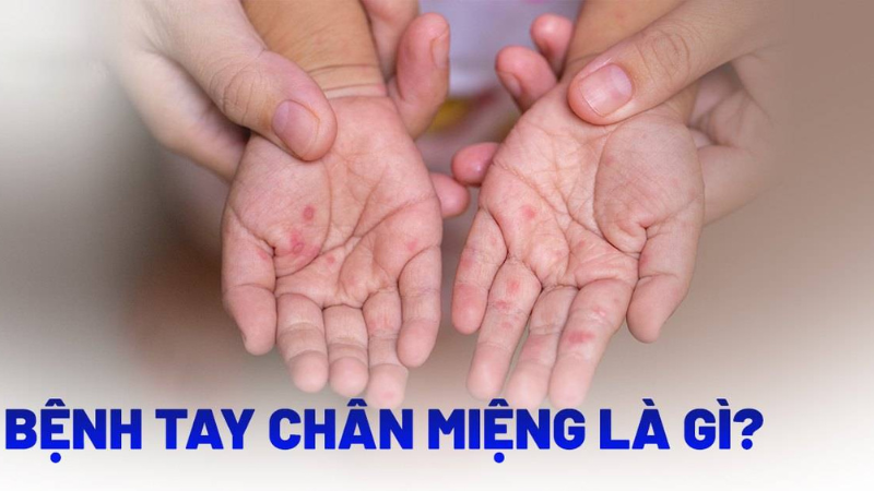 dấu hiệu của bệnh tay chân miệng