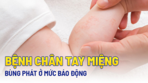 dấu hiệu của bệnh tay chân miệng