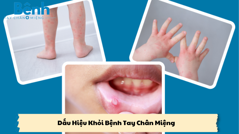 dấu hiệu khỏi bệnh tay chân miệng