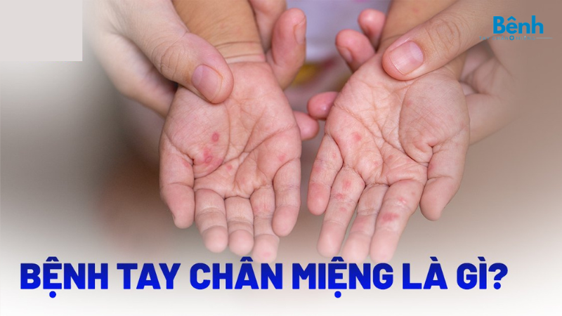 bệnh tay chân miệng là gì