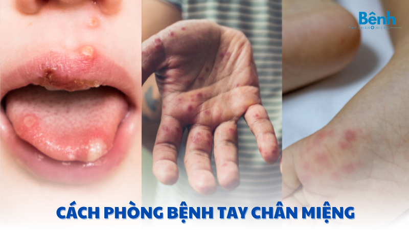 cách phòng bệnh tay chân miệng