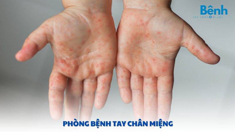 phòng bệnh tay chân miệng