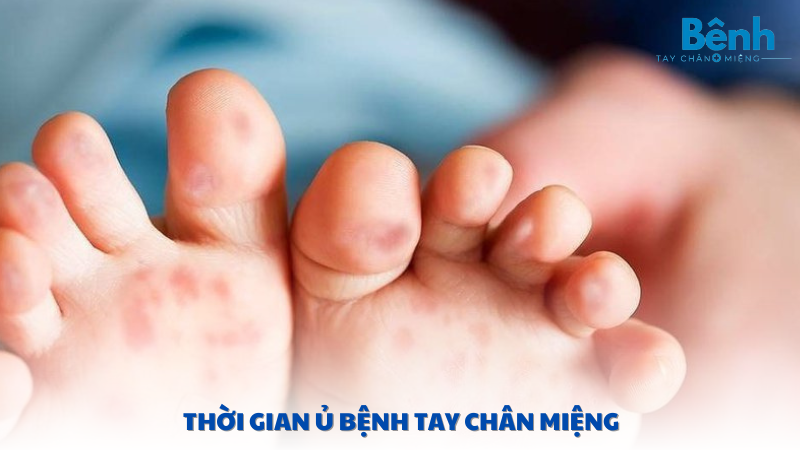 thời gian ủ bệnh tay chân miệng