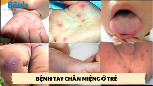 bệnh tay chân miệng ở trẻ