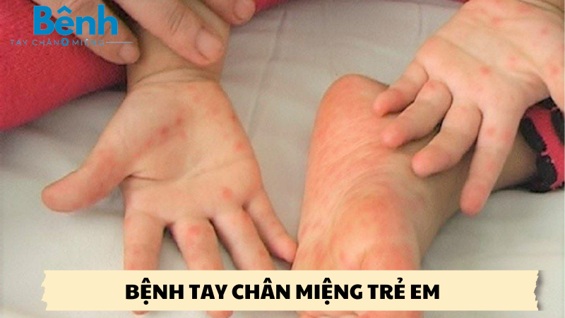 bệnh tay chân miệng trẻ em