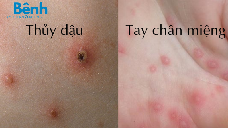 bệnh tay chân miệng trẻ em