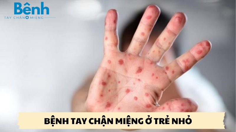 bệnh tay chân miệng ở trẻ nhỏ