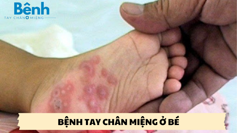 bệnh tay chân miệng ở bé